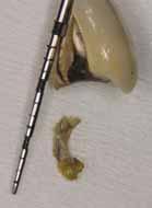 Echte Periimplantitis Das dunkle Kapitel der Implantologie Hat der Patient in seiner Vorgeschichte eine Parodontitis, ist dies ein Risikofaktor