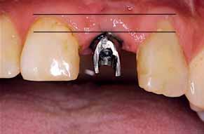 Das periimplantäre Gewebe um das Implantat und das parodontale Gewebe um den Zahn unterscheiden sich in der Beschaffenheit und der Anatomie des