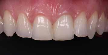 auch für die Restauration einzelner Zähne und für kleine Brücken im Front- und