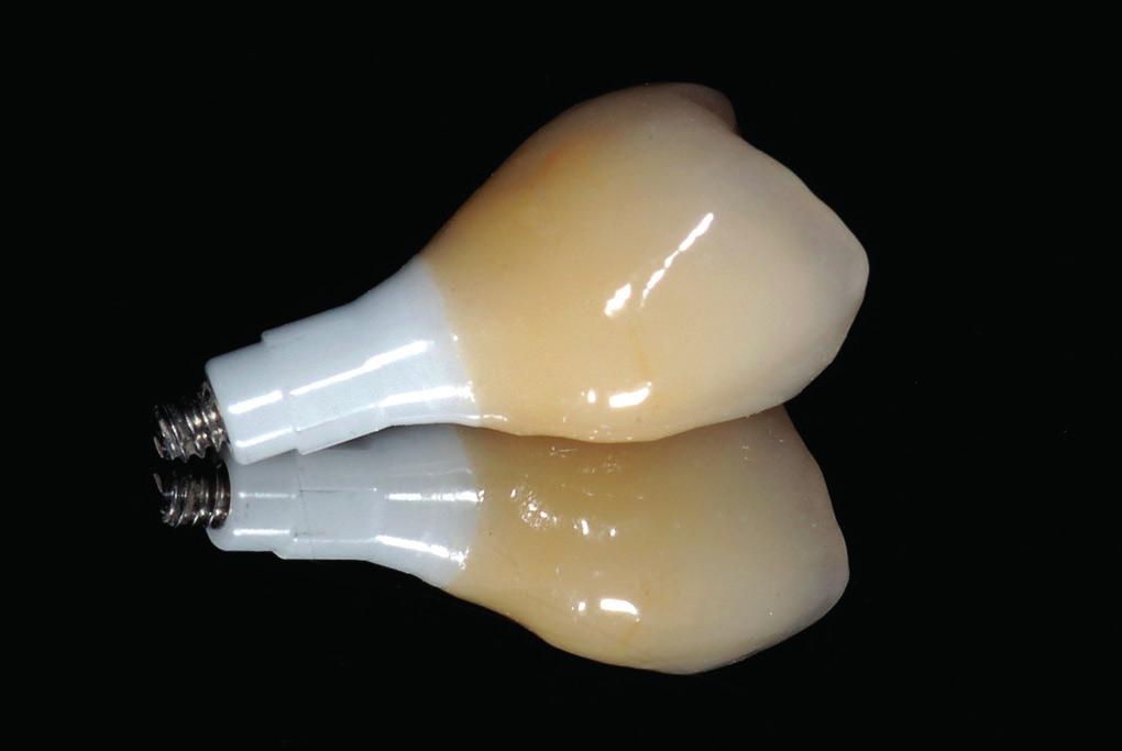 1 Die weiße und rosa Ästhetik der Implantatkrone mitsamt Mukosa architektur muss den zuvor verlorenen Strukturen entsprechen und sich zudem in die vorhandene Dentition harmonisch einfügen.