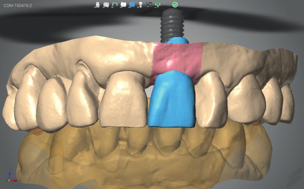 Die Übertragung der 3-D-Implantatposition kann entweder konventionell mit plastischen