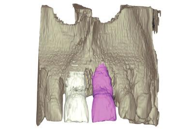 digital dentistry Fachbeitrag Abb. 4a d: DICOM-Segmentierung und Spiegelung des kontralateralen Zahnes zur Imitation des Emergenzprofils mit einem CAD/CAMhergestellten individuellen Healing Abutment.