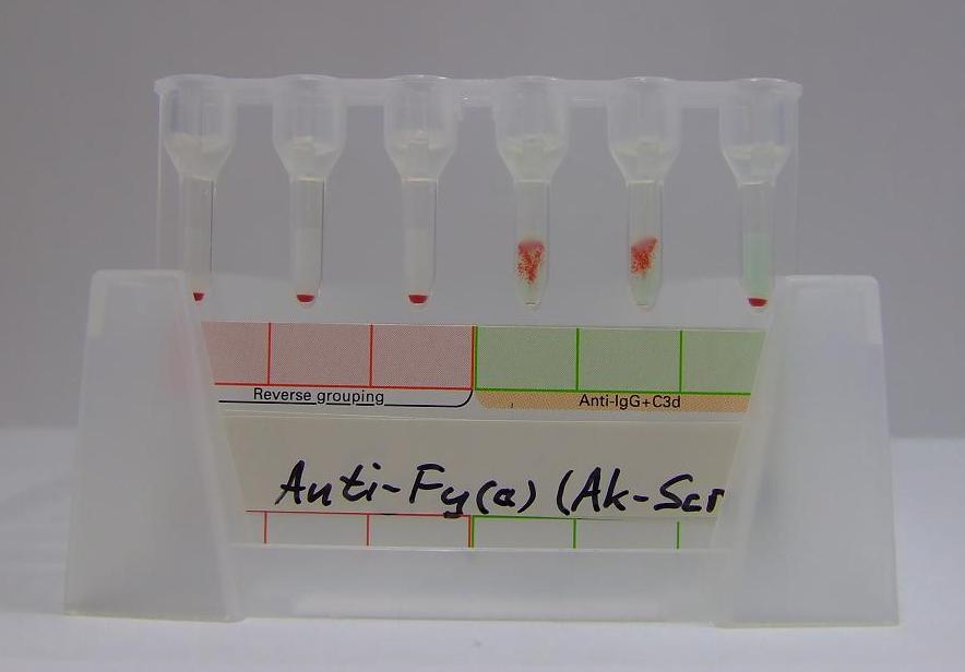 Gelzentrifugationstest Gelzentrifugationstest a b c d 37 38 ABO-Blutgruppenbestimmung Zulässige Konstellationen für ABO-ungleiche Erythrozytentransfusionen Blutgruppe Antigene Isoagglutinine Anti-A