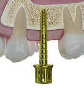 Condenser und MIMI -Verfahren I Im D1- und D2-Knochen ist ein Condenser-Einsatz nicht erforderlich oder