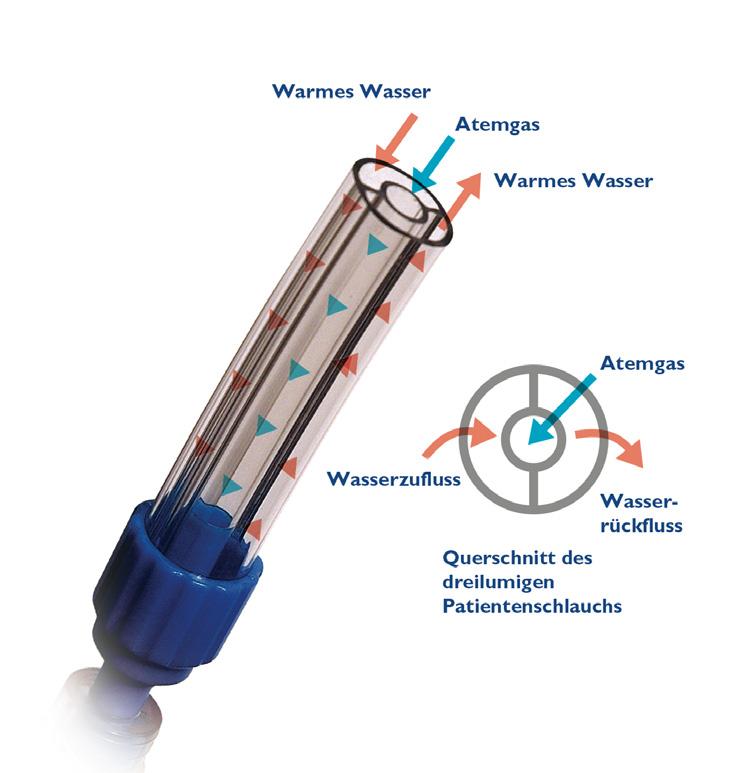 Mit seiner Hi-VNI-Technologie ist der Vapotherm Precision Flow Plus das einzige System, der in einer großen randomisierten Multicenter Studie attestiert wurde, bei der Behandlung von Patienten mit