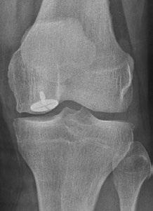 Diese Operationen am Kniegelenk werden größtenteils durch eine Gelenkspiegelung operiert:» Rekonstruktion des vorderen und hinteren Kreuzbands mit Semitendinosus- und Gracilissehne» Rekonstruktion