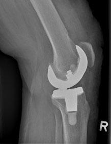 Röntgenaufnahmen von implantierten Knie-Total-Endoprothesen bei Arthrose des Kniegelenks Bei Prothesenlockerungen und beim Austausch von Hüft- als auch von Knie-Total-Endoprothesen, kommt es zum