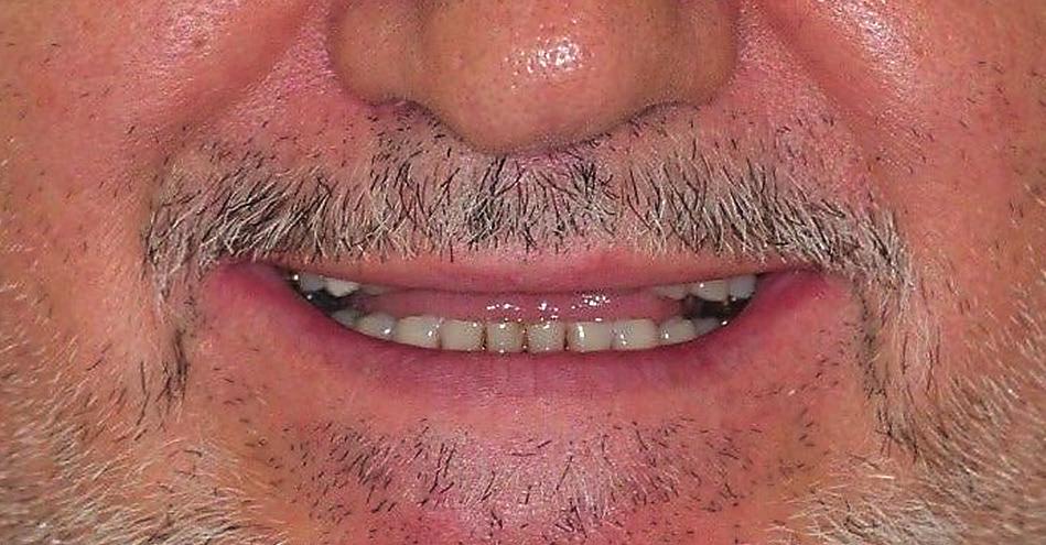 mit im zweiten Quadranten verkürzter Zahnreihe (Abb. 6a e). Alle Zähne sind vital und weisen keine röntgenologischen Auffälligkeiten auf. Die DVT wurde mit dem Orthophos SL (Dentsply Sirona) erstellt.