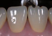 groove Central and incisal orientation