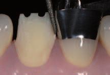 Facial preparation involving 3 levels; oral concavity Proximal separation Cut-back of the incisal edge Finishing and smoothing of the