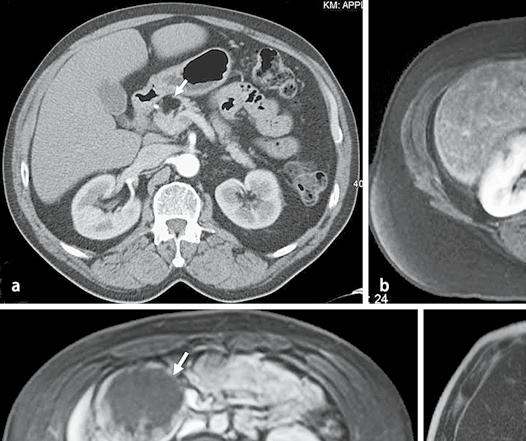 Abb. 1 9 Tpyische Inzidentalome im Pankreas: a Lipom, b Hibernom, c solider pseudopapillärer Tumor, d intraduktale papilläre muzinöse Neoplasie lerdings bis zu 10% der Patienten, die wegen eines