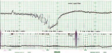 Fetale Überwachung Abb..3 Kardiotokogramm bei Störung der fetalen Versorgung.