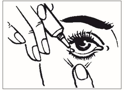 Ob während der Therapie mit Kerato Biciron 5% Kontaktlinsen getragen werden dürfen, entscheidet der behandelnde Arzt.
