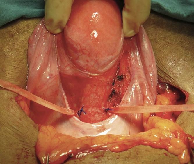Pektopexie bei uterinem