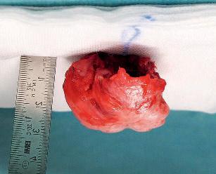 76 a) b) c) Abbildung 2a c Makropräparate eines Osteochondroms (kartilaginäre Exostose) der Scapula eines 12- jährigen Jungen; die mehrere Zentimeter messende Läsion hatte klinisch zu dem Bild einer