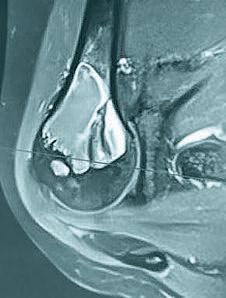 78 Abbildung 5 Solitäre Knochenzyste bei einer 34-jährigen Patientin; die Zyste wurde kürettiert, der Löffel zeigt, dass auch aus den unteren Anteilen die Zystenwand entfernt wurde; anschließend