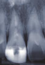Frontzahntrauma. Zahn 11 wurde alio loco endodontisch anbehandelt und ein Schneidekantenaufbau in Nonokklusion mittels Komposit durchgeführt.