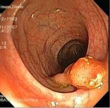 KOLOREKTALES KARZINOM FRÜHERKENNUNGS-KOLOSKOPIE Erwartete und verhinderte