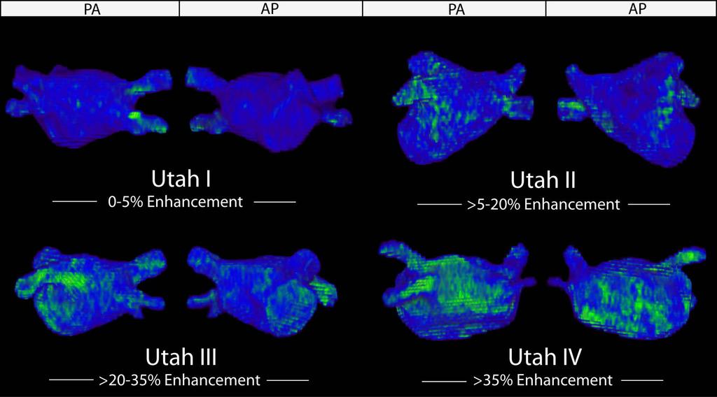 Utah-Score im DE-MRT: Fibrosegrad im linken Vorhof