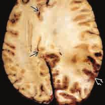 4 Die Nativ-CT zeigt ein Subduralhämatom (SDH) mit subfalziner Herniation des Gyrus cinguli (offene Pfeile), Kompression des linken Seitenventrikels (gebogener schwarzer Pfeil), Foramen