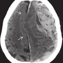 Die Nativ-CT zeigt eine sich rapide entwickelnde akute subdurale Blutung und die subfalzine Herniation des Gyrus cinguli (Pfeile) unter die Falx, die durch die raumfordernde Wirkung bogig verlagert