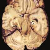 64 3 Sekundäre Folgen und Folgeschäden von Schädel-Hirn-Traumen A B Abb. 3.7 A) Die Autopsie zeigt eine DTH.