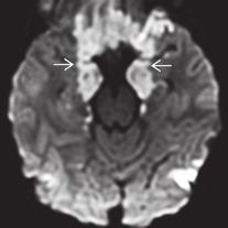 3.1 Herniationssyndrome 65 Herniation sind beide Hirnhälften so geschwollen, dass alle zentral gelegenen Gehirnanteile gegen die Schädelbasis gepresst werden.