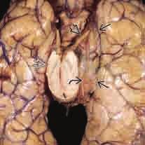 66 3 Sekundäre Folgen und Folgeschäden von Schädel-Hirn-Traumen A B Abb. 3.14 A) In koronarer Reformatierung zeigt sich die ausgeprägte subfalzine und deszendierende Herniation.