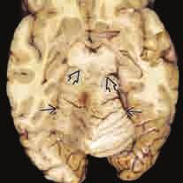 68 3 Sekundäre Folgen und Folgeschäden von Schädel-Hirn-Traumen aus und der untere Teil der Tonsillen wird länglich-spitz.