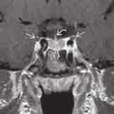 Eine CT im Knochenfenster ist aber unter Umständen hilfreich in der Darstellung des Ausmaßes der ossären Beteiligung im Rahmen invasiver Adenome bzw.