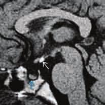 Das Infundibulum fehlt und die Adenohypophyse (blauer Pfeil) ist verkleinert. Der normale bright spot der Neurohypophyse ist nicht in seiner typischen Lokalisation zu fi nden.