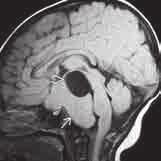 Befunde und Anamnese sind mit einem hypothalamischen Hamartom vereinbar. A B 25 