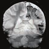 4B). (Man beachte, dass sich die Kalzifikationen im darunterliegenden Hirn befinden und nicht im ihm aufliegenden pialen Angiom).
