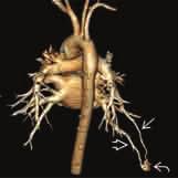 D) Die posteriore 3D-Ansicht der thorakalen CTA desselben Patienten zeigt eine pulmonale AVM (gebogener Pfeil) mit ihrer zuführenden Arterie (gerader Pfeil) und drainierender Vene (offener Pfeil).