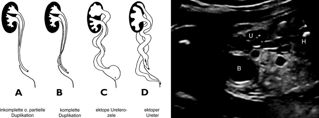 Abb. 9 (a) Schematische Darstellung verschiedener Ureteranomalien sowie (b) sonographische Darstellung eines Feten mit einer obstruktiven Uropathie des unteren Harntraktes mit vergrößerter Harnblase,