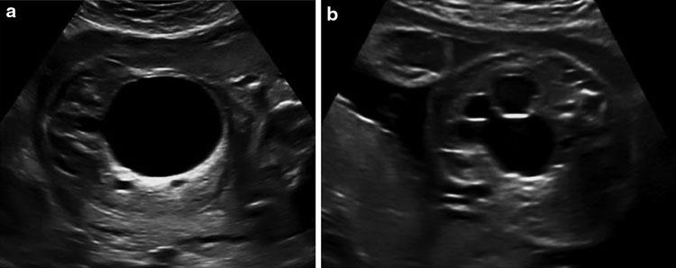Abb. 10 (a-c) Sonographische Darstellung einer Refluxuropathie infolge einer Ureterozele bei einem Feten in der 20.