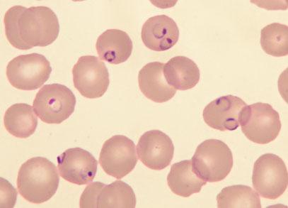 Malaria 7 der Parasitenspezies und der Parasitämie nachgeholt werden. Mittels PCR kann die DNA von Plasmodien speziesspezifisch nachgewiesen werden.