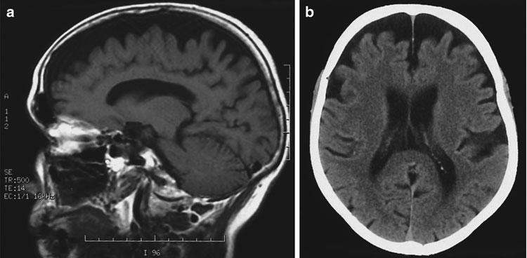 Alzheimer-Demenz und andere degenerative Demenzen 7 Abb. 2 a,b Frontotemporale Demenz: frontale Atrophie.
