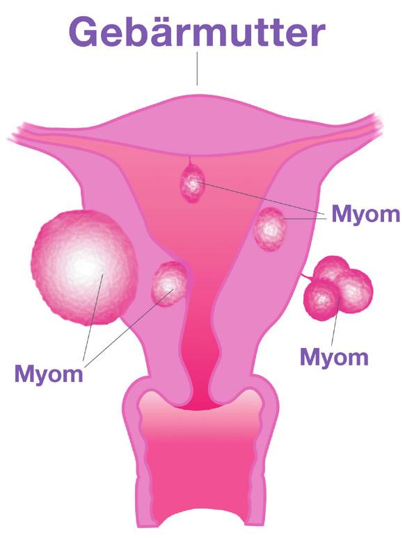 Das spricht man so aus: Mi-jome. Viele Frauen haben Myome. Myome sind nicht die Krankheit Krebs. Sie können auf dem Bild sehen, wo es Myome geben kann.