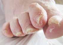 Beschleunigtes Wachstum Sommer tagsüber Schwangerschaft Bagatellverletzungen Nagelbeißen Nagelschneiden Nägel der rechten Hand jugendliches Alter Männer Finger Mittelfinger Ringfinger Zeigefinger