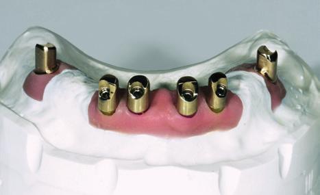 ldung 39 (Teil 1, ZWL 4/18) erkennbar war, liegt im ausgekehlten Bereich der vestibuläre Anteil vom Zahnhals. Abb.