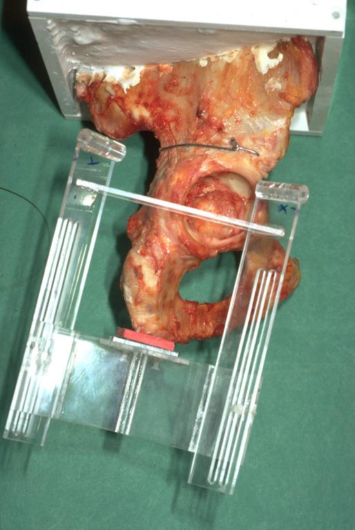 ischiadicum und den Tuber ischiadicum, die negative Z-Achse durch das anteriore Pfannendach in Richtung auf die Spina iliaca anterior inferior. 4.