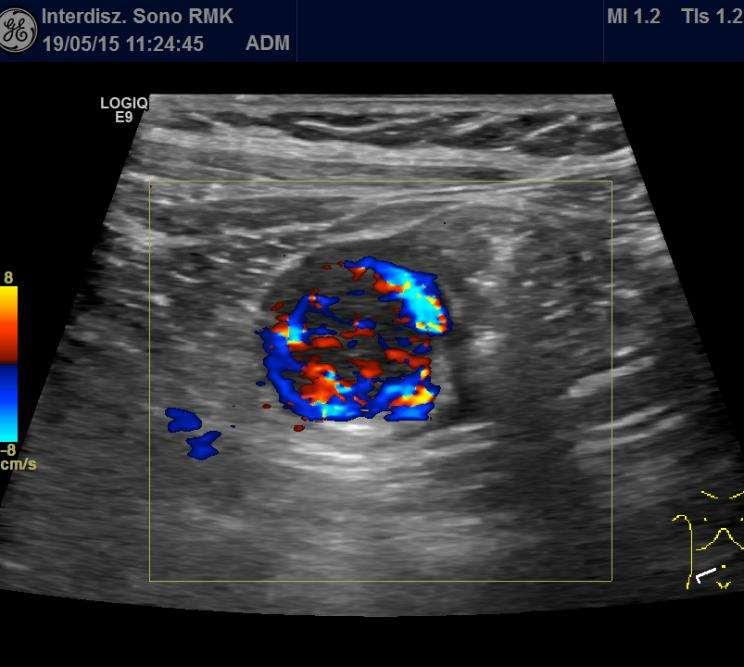 Ohba G et al: The Usefulness of Combined B Mode and Doppler Ultrasonography to Guide Treatment of