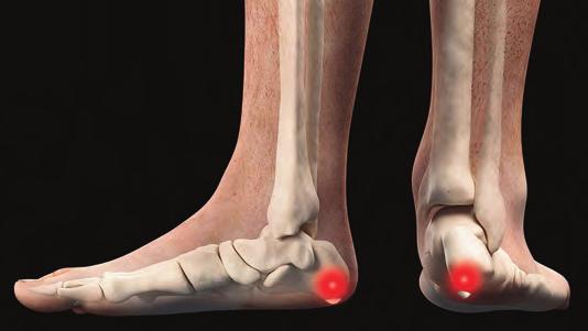 ANZEIGE Orthopädie-Schuhtechnik Seidl GmbH Fersenschmerzen? Statik prüfen! Schmerzende Füße nur passiv bequem zu betten, kann böse Folgen haben Fersenschmerzen können viele Ursachen haben.