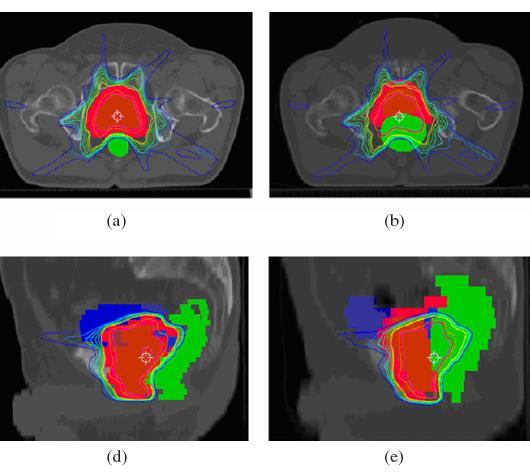 Einfluss der Patientenbewegung Wertz et al, Han et al, Zhang et al Interfraktionelle Bewegung von Prostata und Cervix-Ca Patienten wiederholte CT Studien Prostata Δx = 7.6 ± 4.2 mm Δx Max = 14.