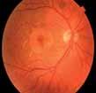 Bei stark herabgesetzter Sehschärfe oder stark exzentrischer Fixation kann das Amsler-Netz nicht verwendet werden. Was sieht der Augenarzt?