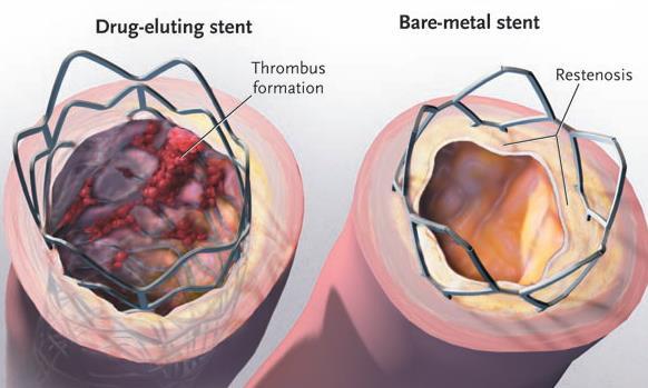 Stents beschichtete Stents