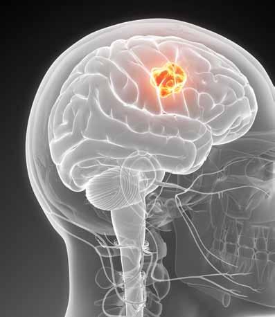 Radiotherapie des Neurocraniums beim