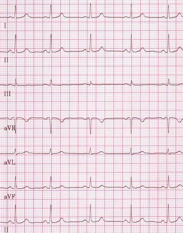 Diagnose - Elektrokardiogramm (EKG) Einfach Elektrische Herzaktivität wird aufgezeichnet Anhaftende