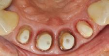 kalkulierte Viskosität wird der Sulkus effektiv geöffnet, ohne Schäden am epithelialen Attachment